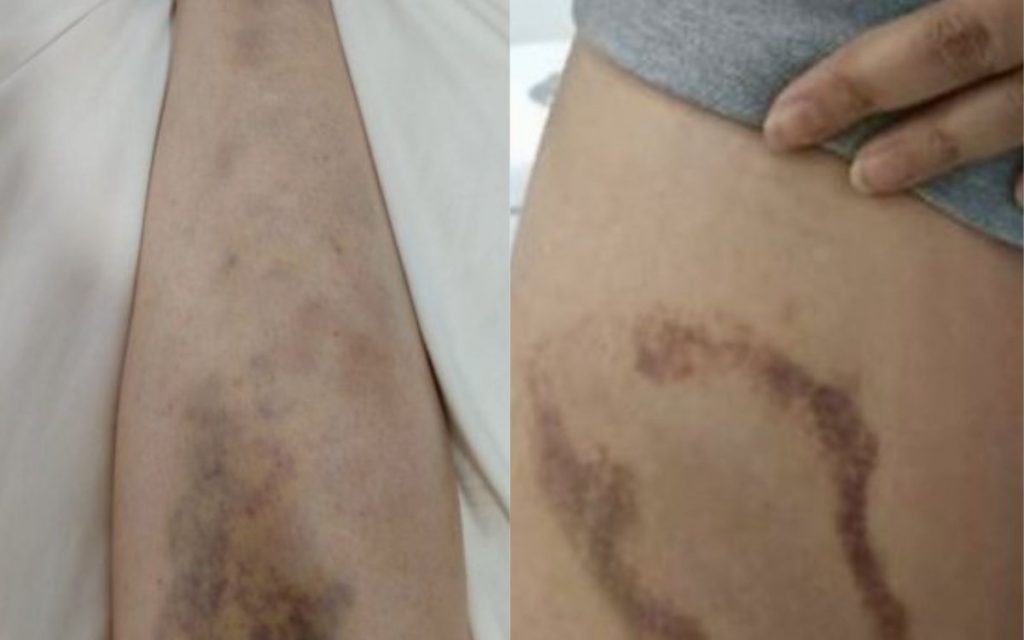 Denuncian agresión a trabajadora en residencia de menores de Quillota